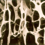 Osteoporosis - Brittle Bone Disease