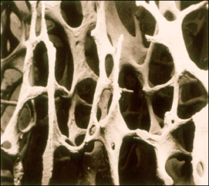 Osteoporosis - Brittle Bone Disease